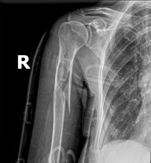 X-ray of right broken arm from scooter accident